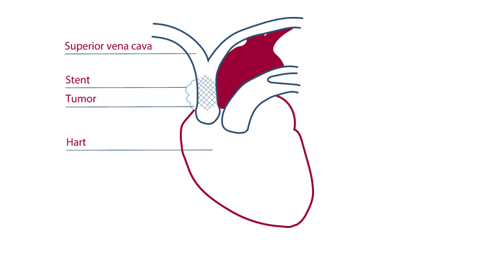 piek Maxim de eerste Vena cava stent | Interventieradiologie AVL