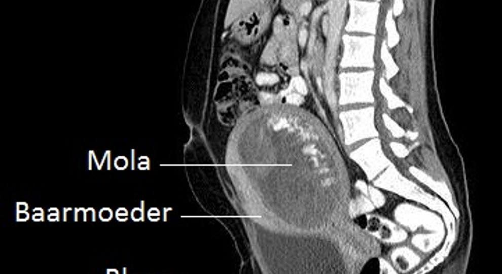 Trofoblast 4 Voorhetgesprek CT Mola